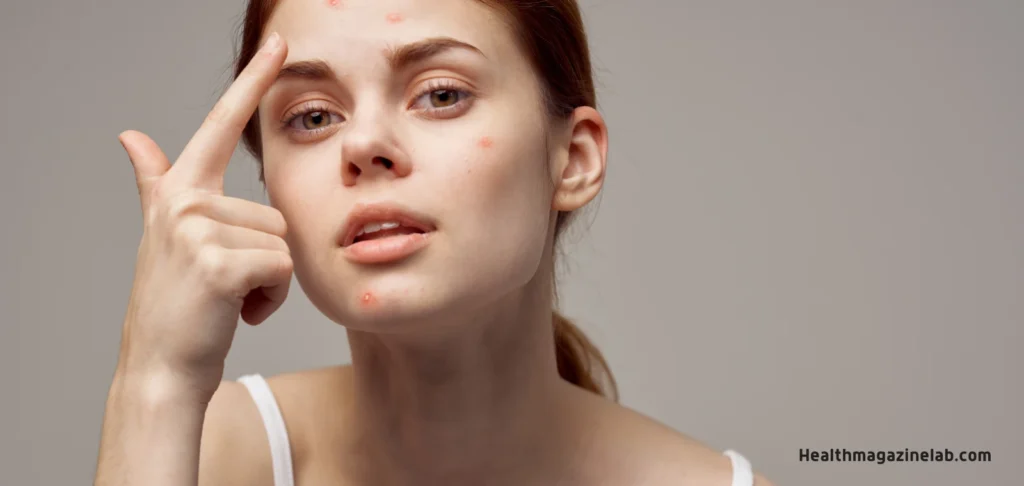 Will losing weight help acne?